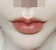 입꼬리수술한지 3개월 됐어용 ㅎㅎㅎ