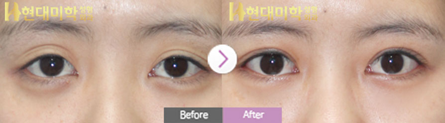 눈절개 재수술, 눈매교정, 뒤트임, 밑트임,상안검