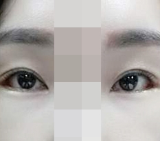 뒤트임,밑트임 ♥~