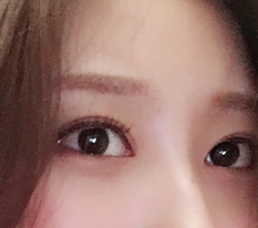눈성형은 역시 현대미학~ㅎ