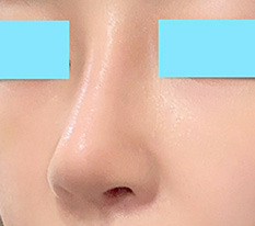 코재수술 후기 올립니당 ㅎ,ㅎ