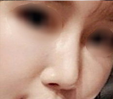 현대미학에서 코재수술했습니당 완전 만족해용^^