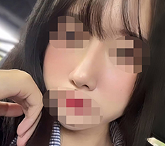 낮은코 해결