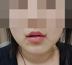 입꼬리성형 했어요~~