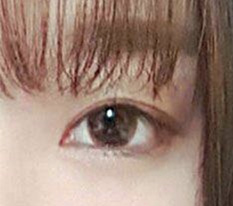 쌍수와 트임술 직접 해본 후기 올립니다 ㅎㅎ