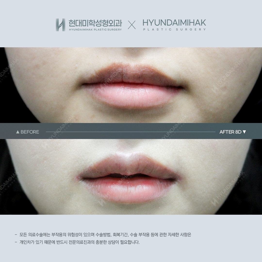 [입술성형] 큐피트 입술성형 1개월 차