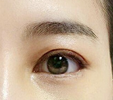 눈재수술 받은지 일주일 지났어용^^