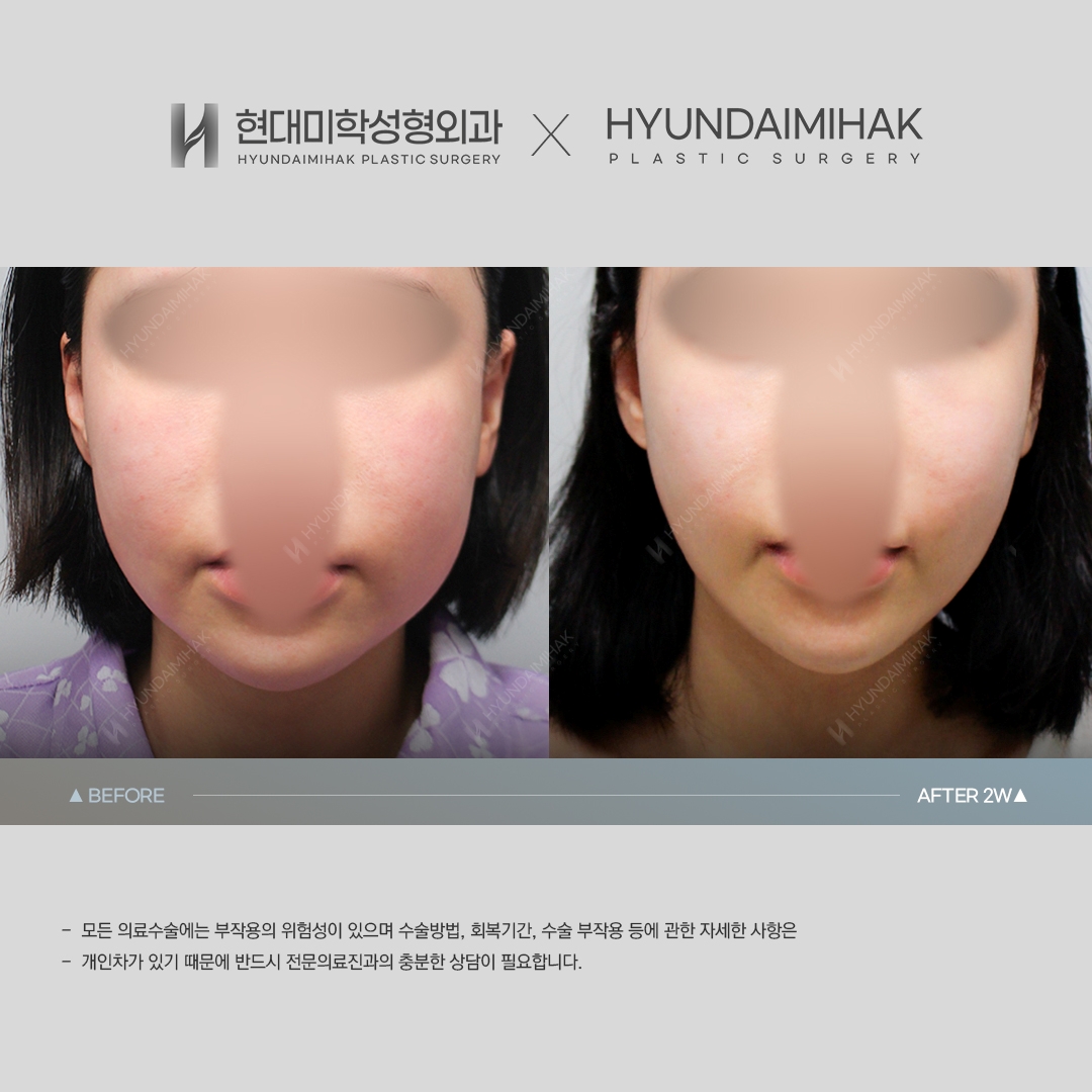 [동안성형] 실리프팅 2주 차