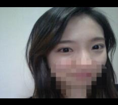 쌍꺼풀 절개 앞트임 수술 후기.. 이제서야 씁니다 ㅋㅋ