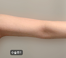 팔뚝 스트레스 없어졌어요 ㅎㅎ