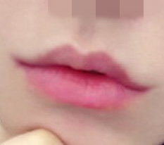 입꼬리수술 덕분에 자신감 upㅋㅋ