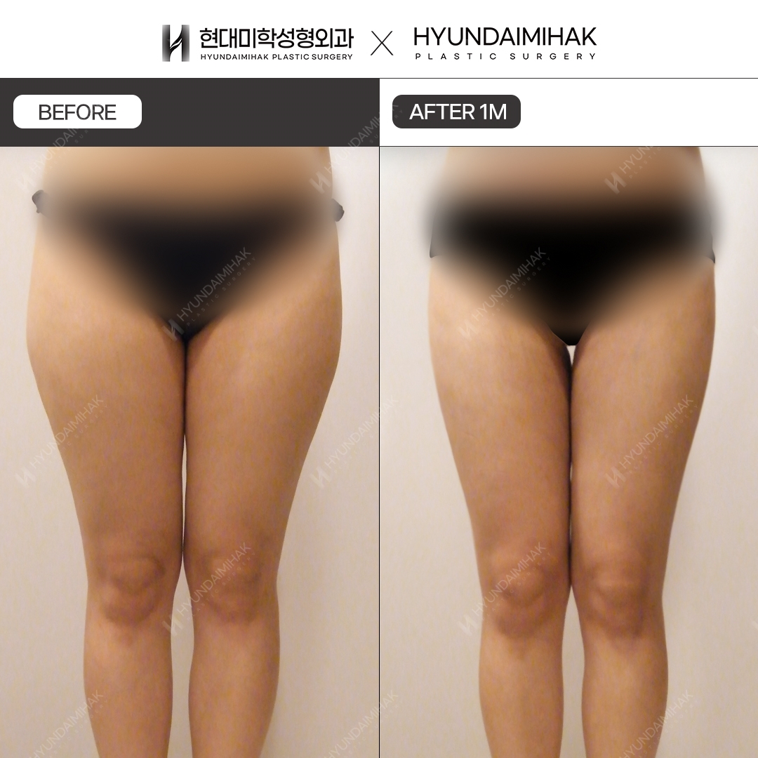 허벅지 지방흡입 1개월차
