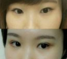 눈성형을 왜 이제 했을까요 ㅋㅋ