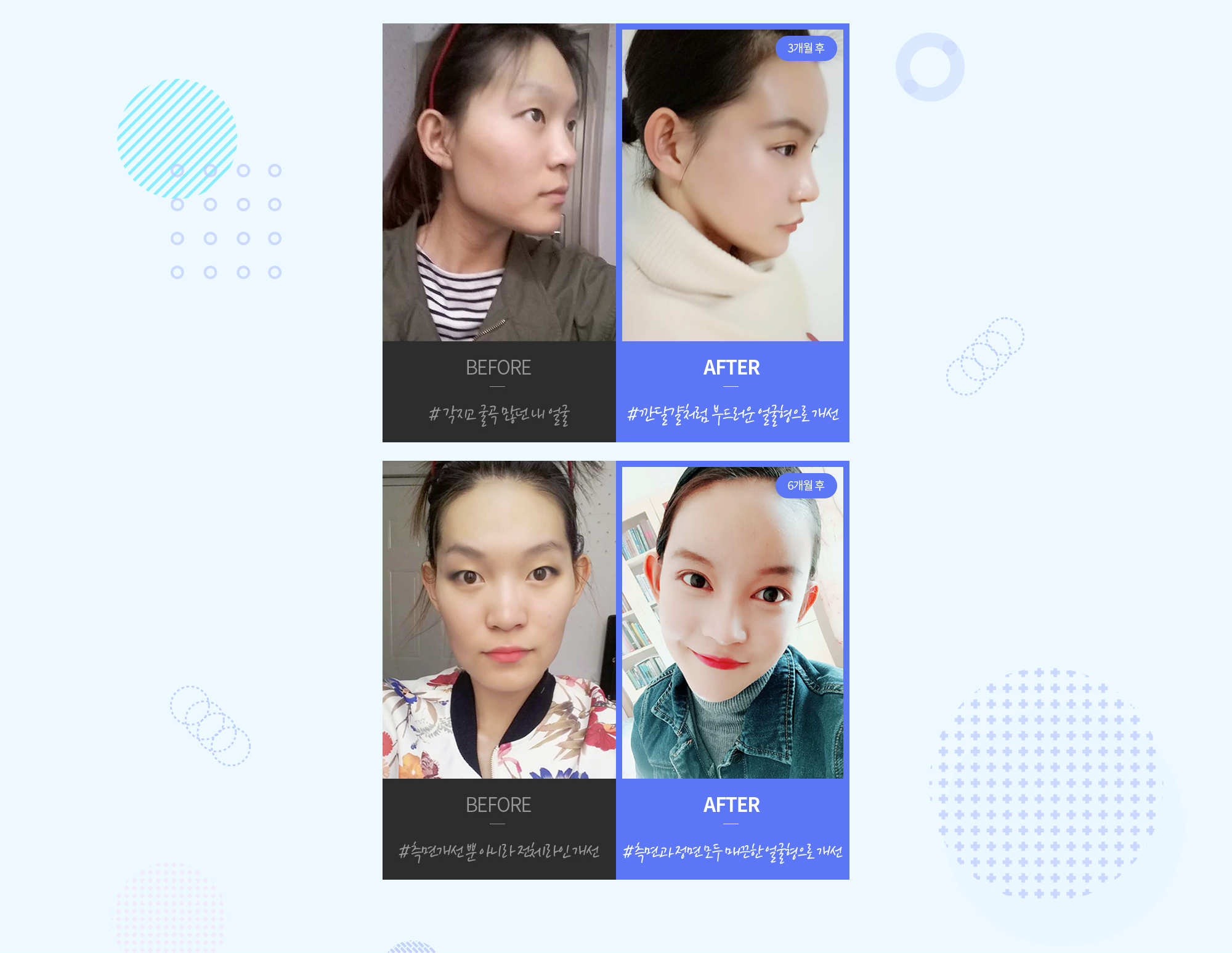 현대미학 광대축소술 REAL 전후사진 — CASE 1: 정면·측면 BEFORE/AFTER (#각지고 굴곡 많던 내 얼굴 → #깐달걀처럼 부드러운 얼굴형으로 개선, 6개월 후). CASE 2: 정면·측면 BEFORE/AFTER (#측면개선 뿐 아니라 전체라인 개선 → #측면과 정면 모두 매끈한 얼굴형으로 개선, 6개월 후).