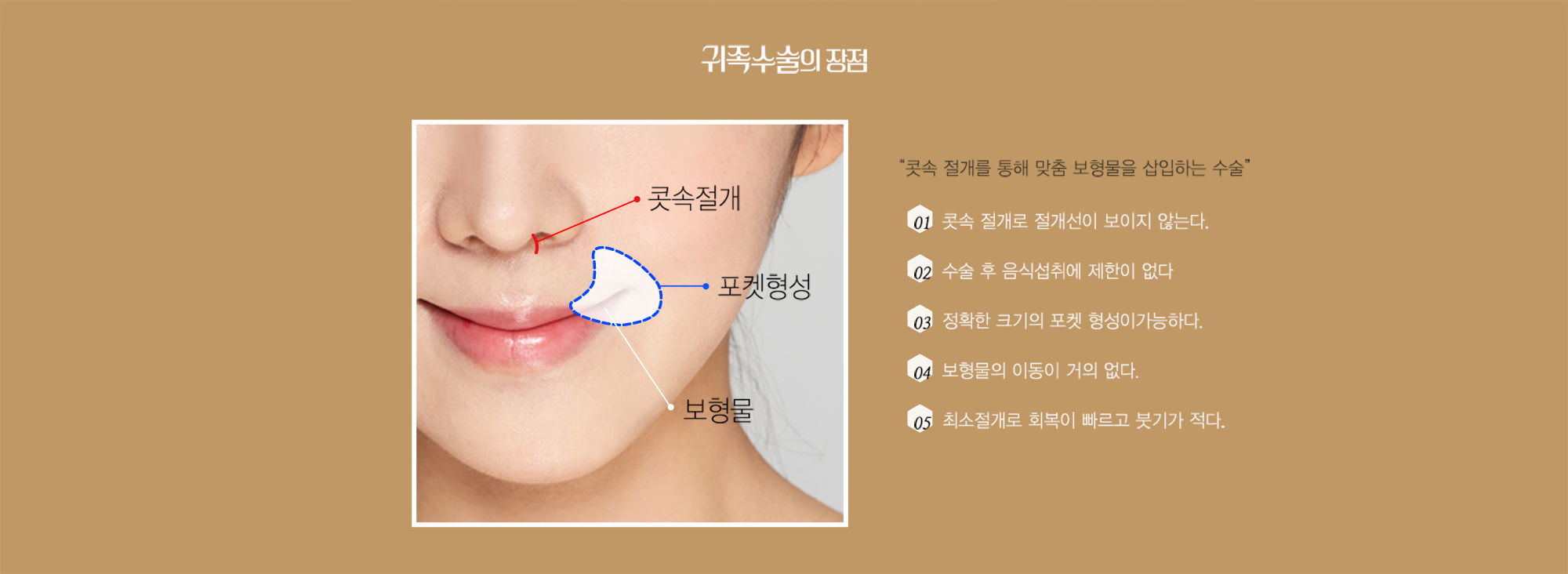 귀족수술의 장점 — 콧속절개·포켓형성·보형물 다이어그램과 다섯 가지 장점