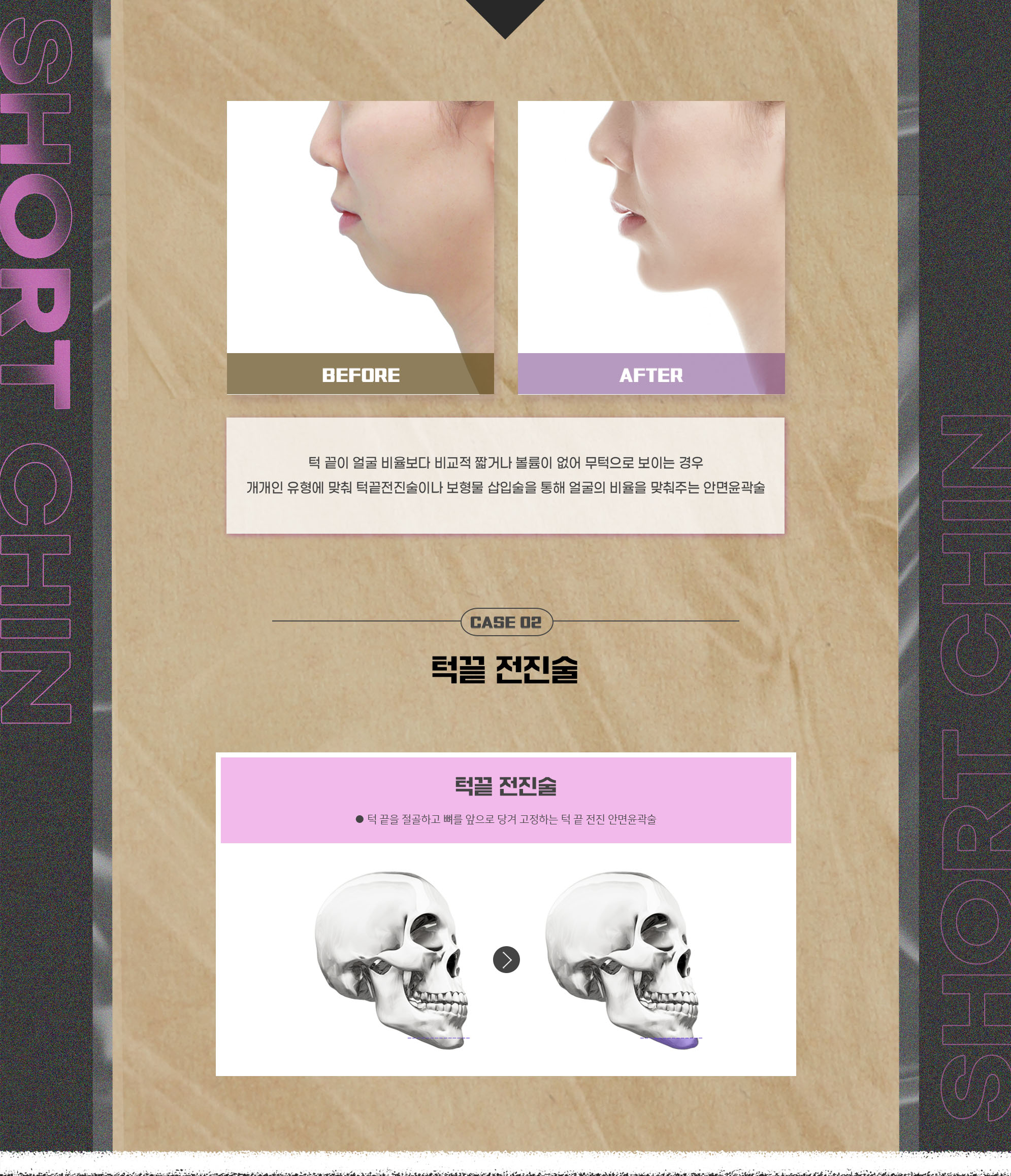 CASE 02 턱끝이 짧고 무턱 — 수술 전후 사진과 턱끝 전진술 안내