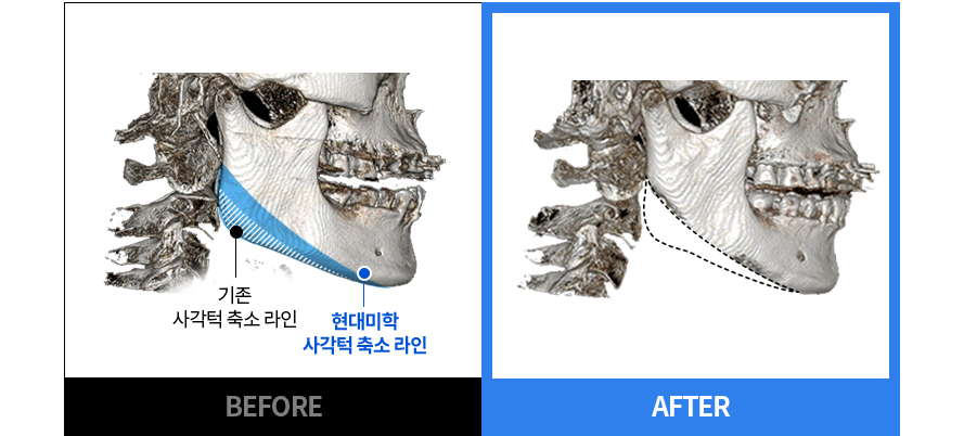 기존 사각턱 라인과 현대미학 사각턱 축소 라인 BEFORE / AFTER CT 비교
