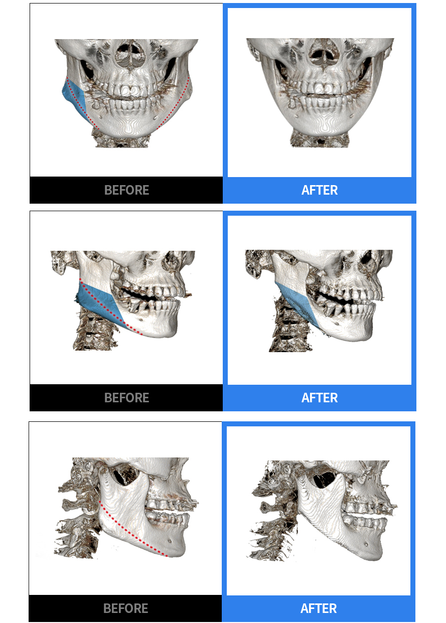 사각턱 축소 전후 정면·측면 BEFORE / AFTER CT 비교