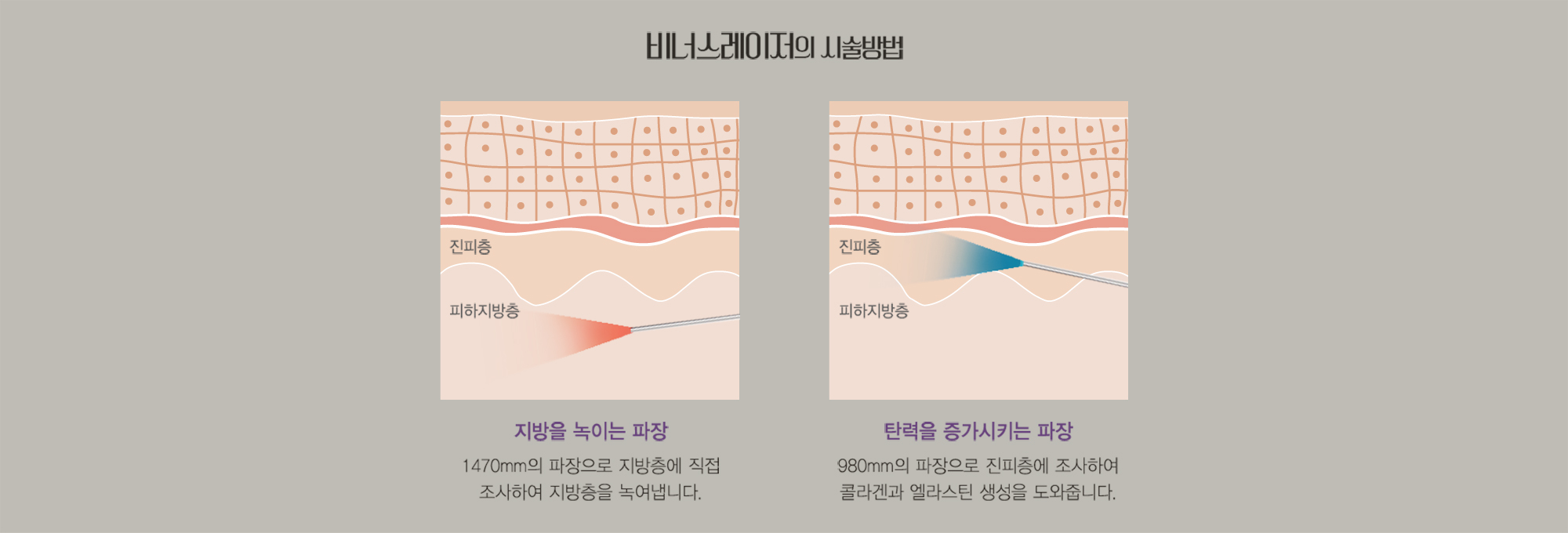 비너스레이저의 시술방법 — 진피층·피하지방층 단면 다이어그램과 두 파장 설명
