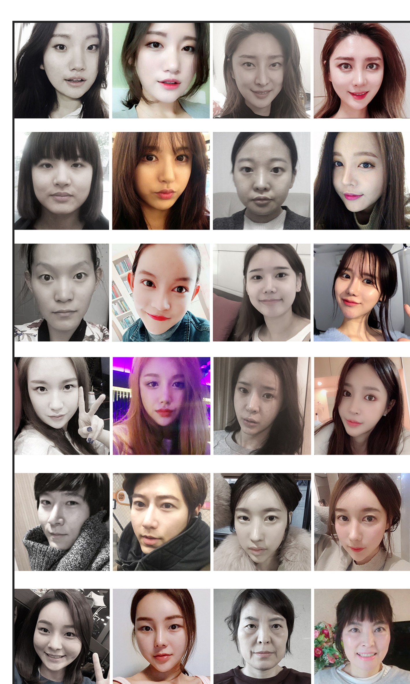 현대미학 트임재수술 BEFORE & AFTER 사례