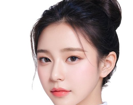 뒤트임성형 결과 모델 — 가로로 시원하게 확장된 눈매