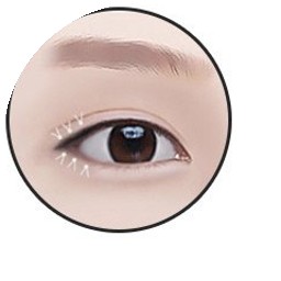 뒤트임 4단계 — 녹는실 고정봉합