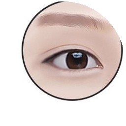 뒤트임 5단계 — 가로길이 확장된 시원한 눈매 완성