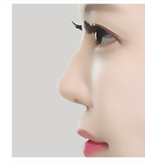 매부리코 측면 사례 2