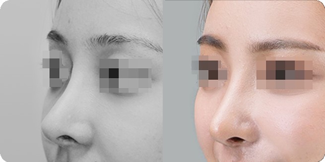 무보형물 코성형 전후 측면 비교 1 (BEFORE / AFTER 3MONTH)