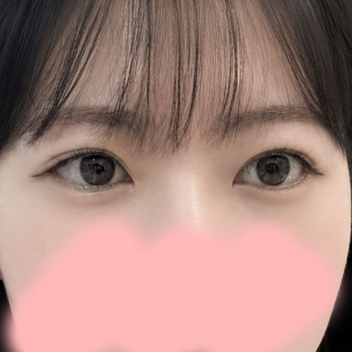 눈재수술 후기