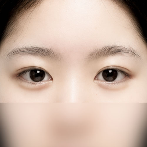 눈재수술 후기