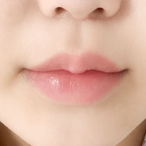 입꼬리 성형 후기예요