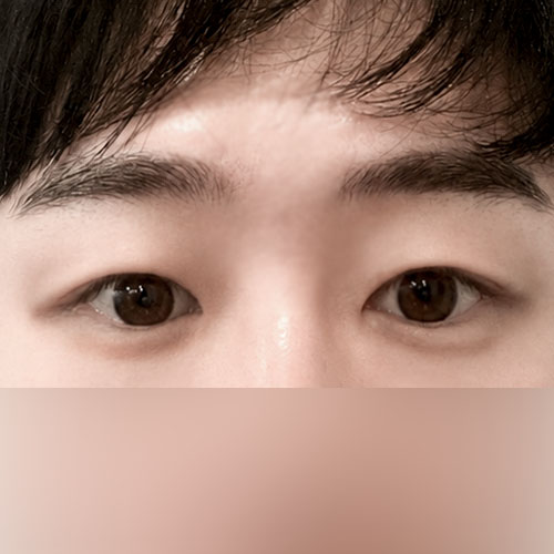 남자눈성형 후기
