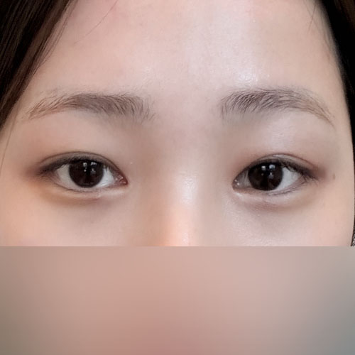 눈재수술 하길 잘했죠ㅎㅎ