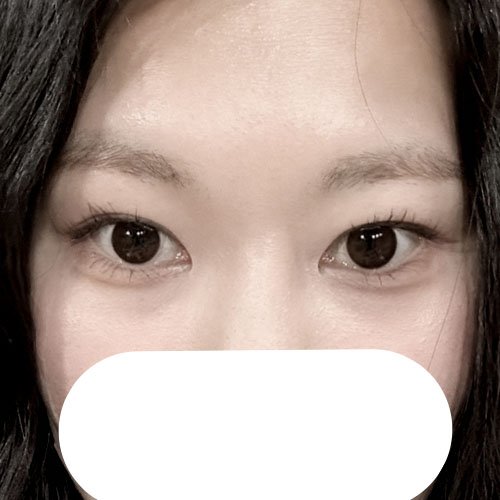 현대미학에서 인아웃라인 수술 받은 후기