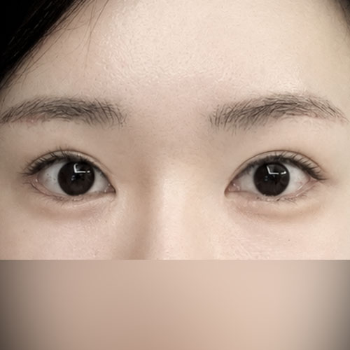 나 눈 어때?