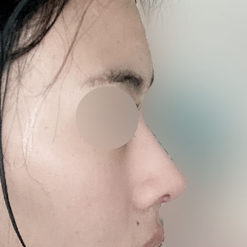 절골 안해도 되더라