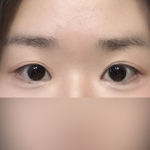 쌍수 잘 된 듯