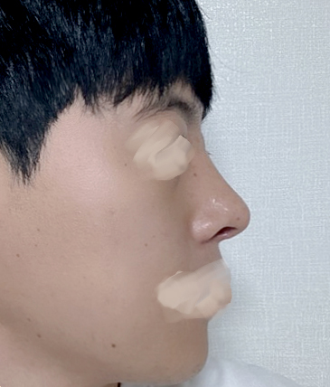 코성형 2주차ㅋㅋㅋ