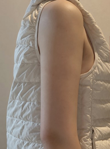 팔 지방흡입 만족~