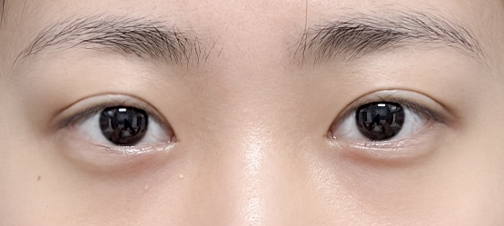 처음으로 쌍수했는데 잘 된 것 같아요 ㅎㅎ