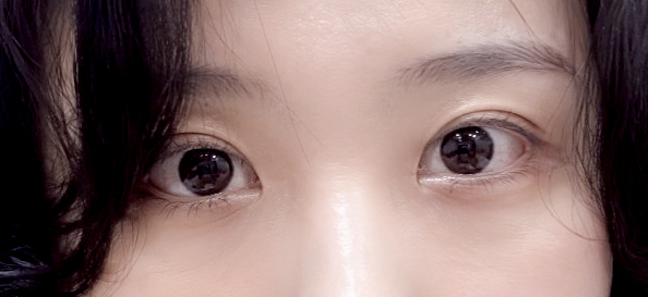 눈재수술 다신 없을 것 같다