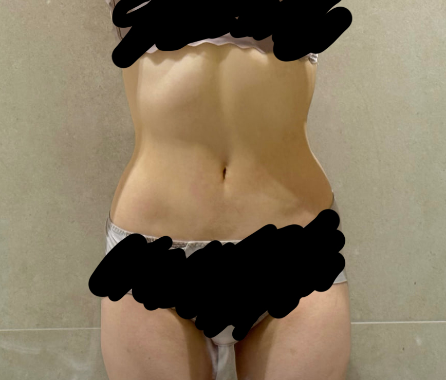 복부지흡후기