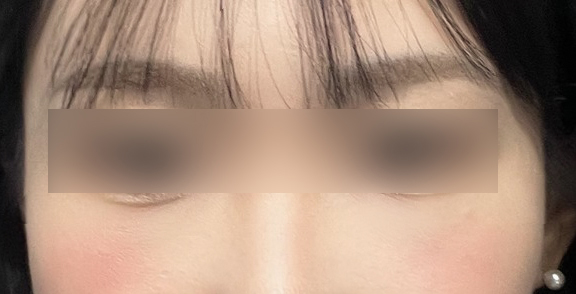 멍과 붓기 생각보다 빨리 사라졌어ㅋㅋ