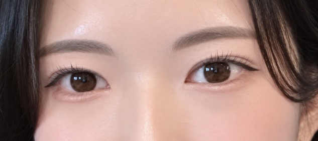 수술한지 한달차 ㅋㅋ