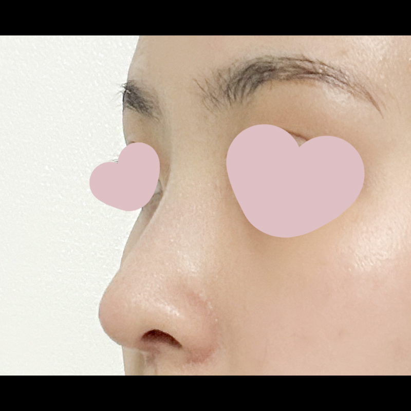 이제 코재수술 그만하고 싶어요